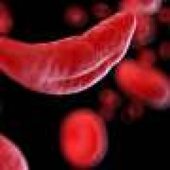 Sickle cell disease is 11 times more deadly than previously recorded, suggests study