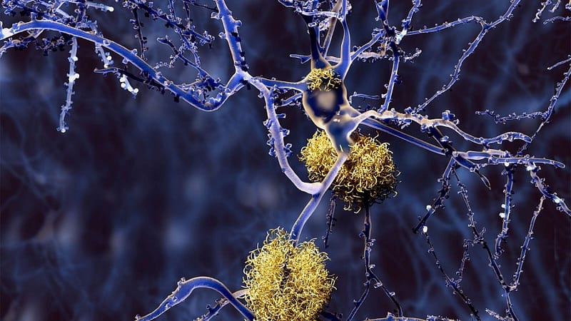 Subcutaneous Alzheimer’s Drug May Be on the Horizon